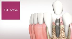 implanturi-dentare-isII-active